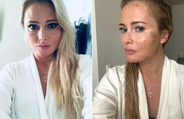 Дана Борисова до и после подтяжки лица нитями