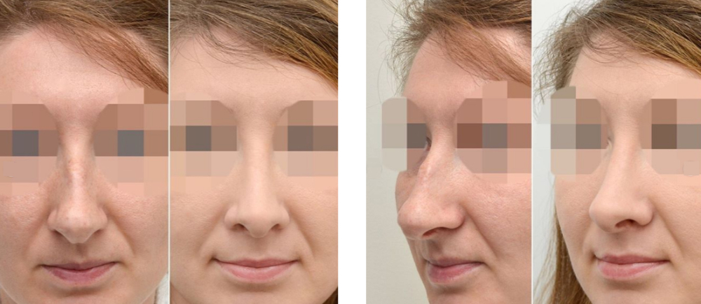 ринопластика Валерий Стайсупов