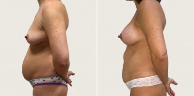 Абдоминопластика Пшонкина