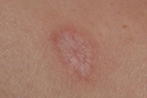 Удаление родинки шрам