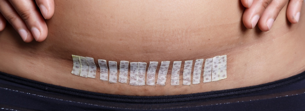 Шов после абдоминопластики