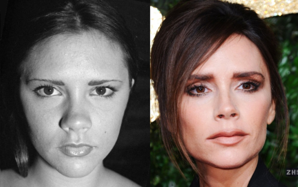 Виктория Бэкхем до и после удаления комков Биша