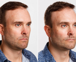 Муж «вечно недовольной» женщины сделал пластику лица