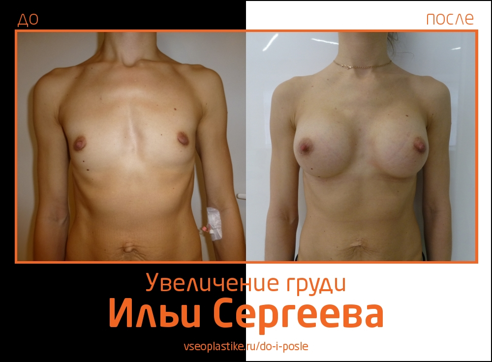 Фото до и после увеличения груди у доктора Ильи Сергеева