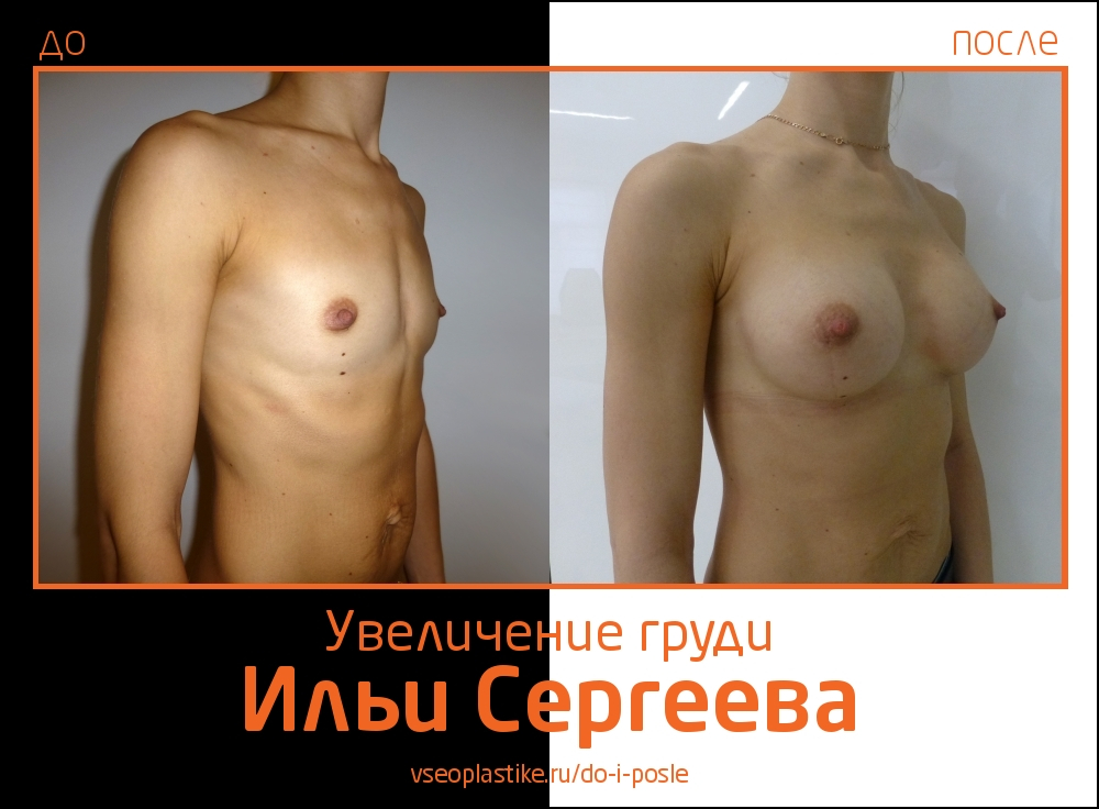 Фото до и после увеличения груди у доктора  Сергеева