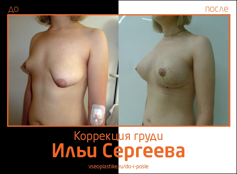 Илья Сергеев.  Фото до и после коррекции асимметрии молочных желез