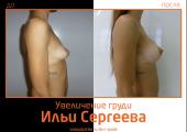 Илья Сергеев.  Фото до и после увеличения груди