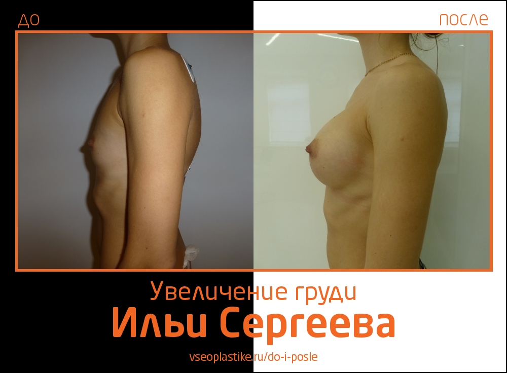 Фото до и после увеличения очень маленькой груди у Ильи Сергеева