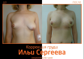 Илья Сергеев.  Фото до и после коррекции груди