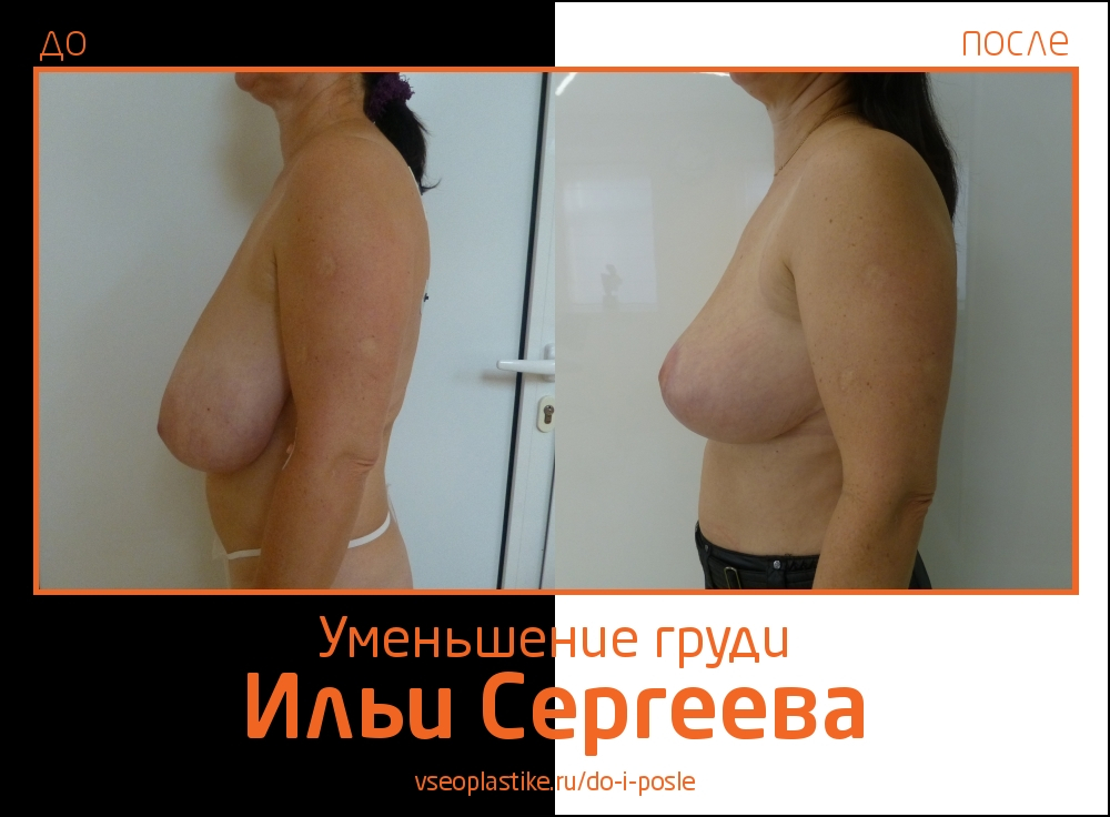 Илья Сергеев.  Фото до и после уменьшения груди и мастопексии
