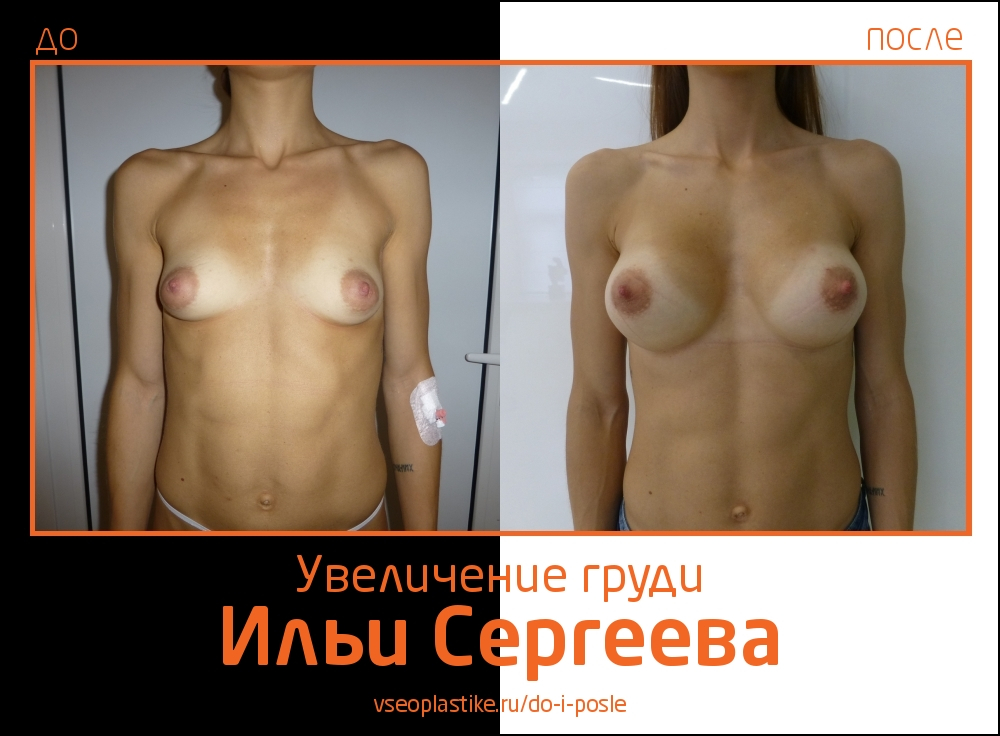 Илья Сергеев.  Фото до и после аугментационной маммопластики