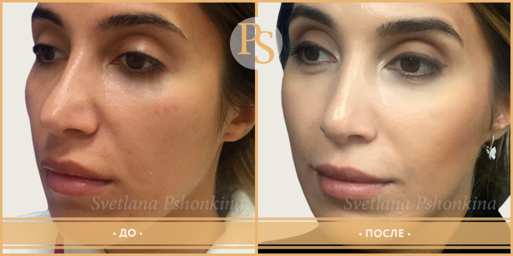 Фото до и после повторной ринопластики у доктора Светланы Пшонкиной