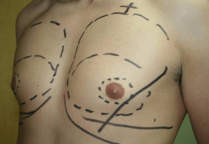 Виды и причины гинекомастии