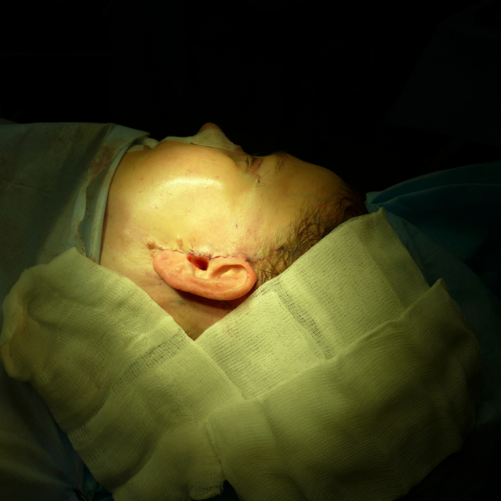 Конец операции. Наложены швы