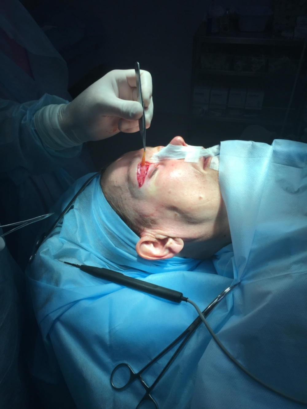 Выделение грыж верхнего века для их удаления