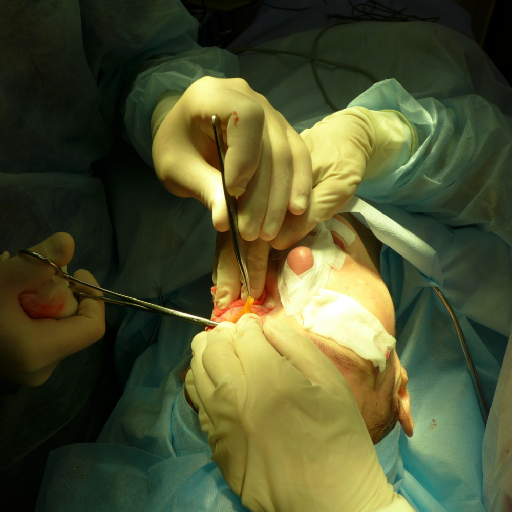 Извлечение и удаление внутренней, внешней и срединной грыж