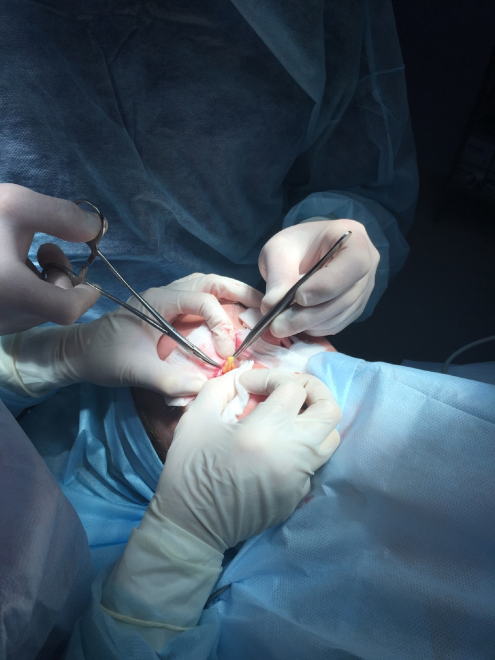 Удаление грыж нижнего века трансконъюктивальным способом