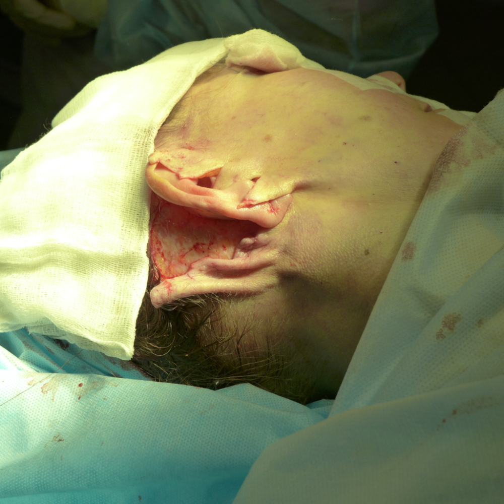 Избытки кожи перед их иссечением