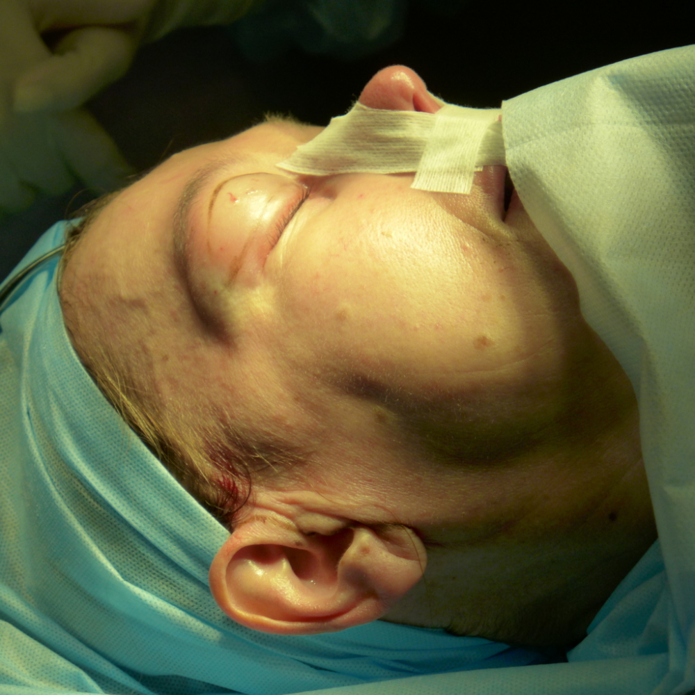 Перед началом. Есть разметка для верхней блефаропластики