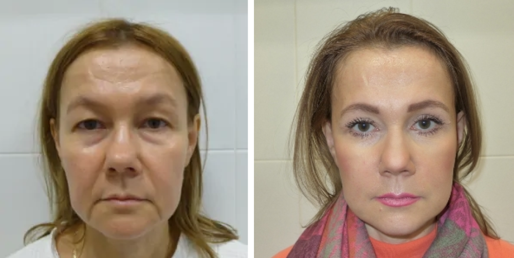 Пациентка до и после операции у доктора Михайлова