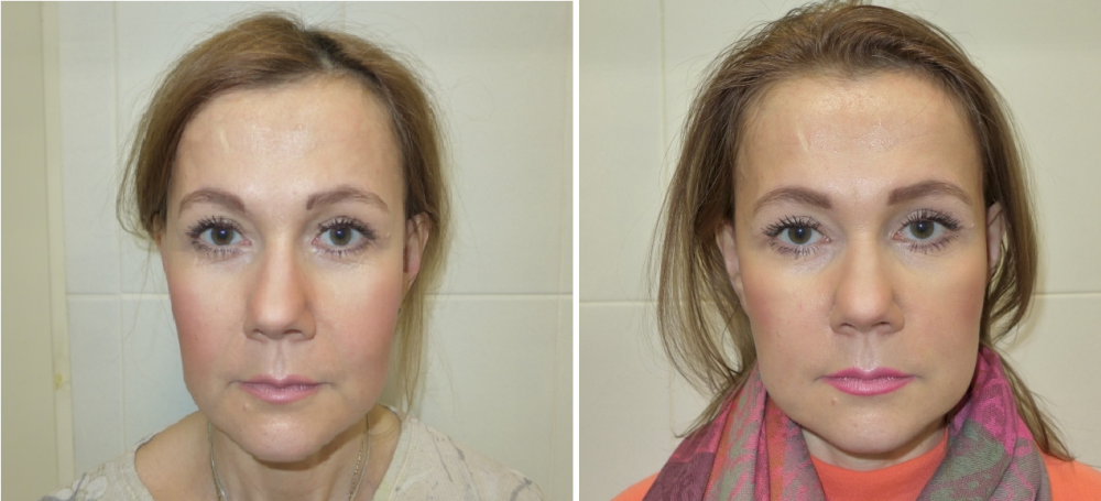 Пациентка через 1,5 и 2 месяца после операции