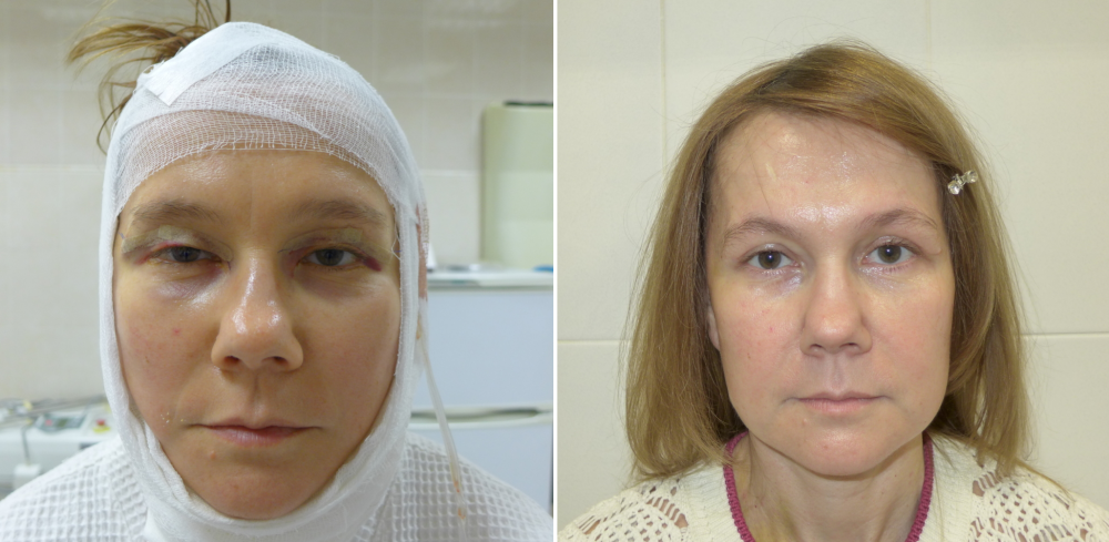Пациентка через сутки и 3 недели после операции