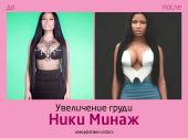 Ники Минаж до и после увеличения груди