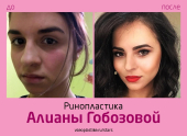 Алиана Гобозова до и после риносептопластики