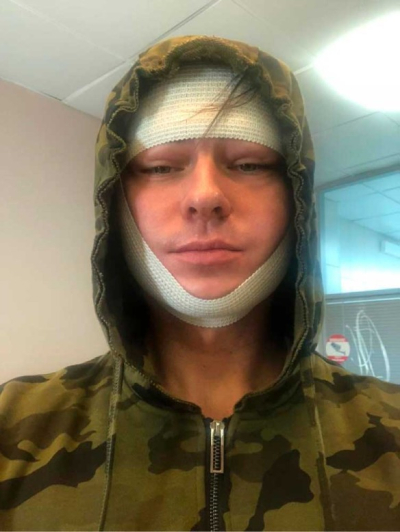 Фото Прохора Шаляпина после подтяжки лица