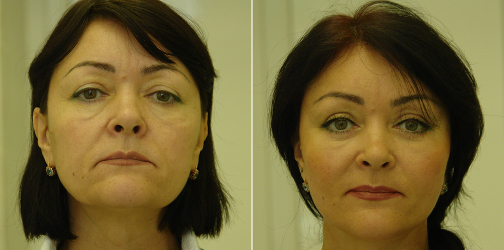 Валерий Якимец подтяжка лица фото