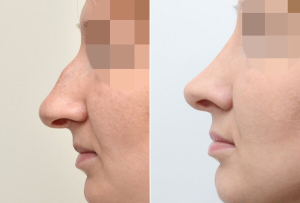 Удаление горбинки Стайсупов