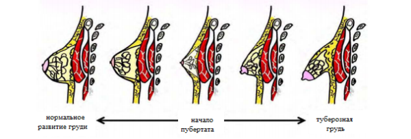 Нормальное и аномальное развитие груди