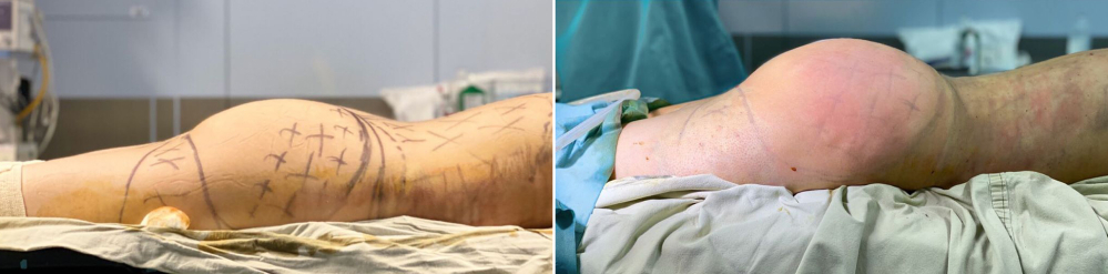 Липофилинг ягодиц Карен Пайтян