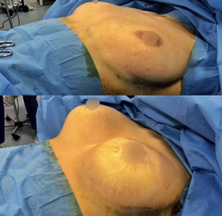 Подтяжка и увеличение груди у доктора Куприна