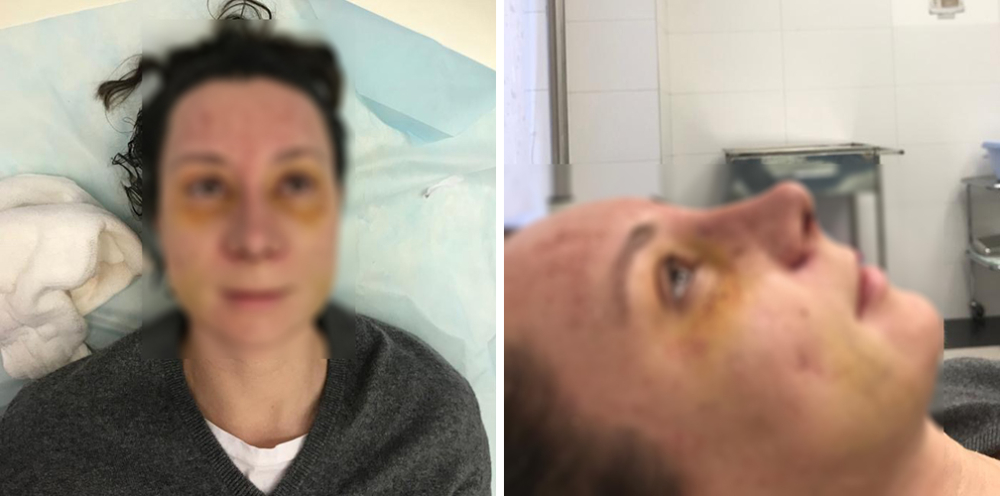 Визаж Лифт и ринопластика