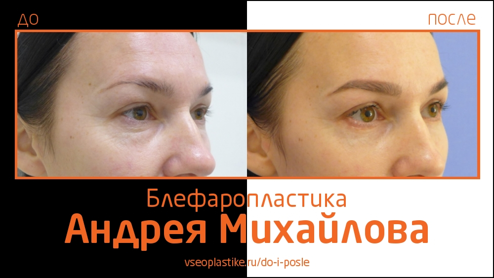 Андрей Михайлов. До и после блефаропластики