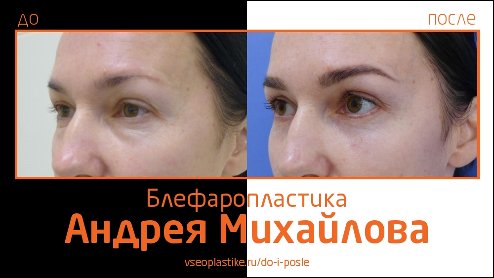 Андрей Михайлов. До и после блефаропластики