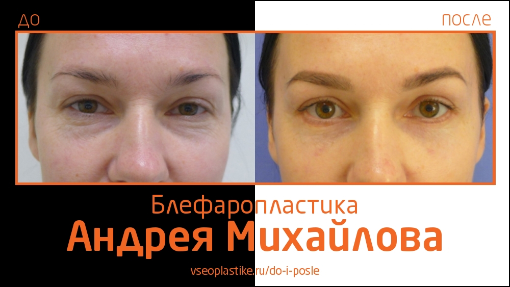 Андрей Михайлов. До и после блефаропластики