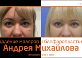 Андрей Михайлов. До и после удаления малярных мешков и пластики век