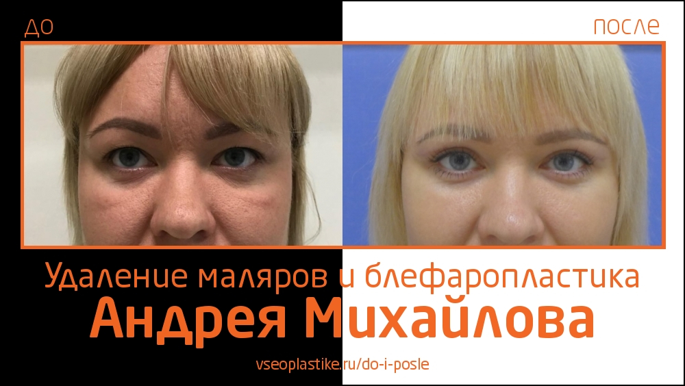 Андрей Михайлов. До и после удаления малярных мешков и пластики век