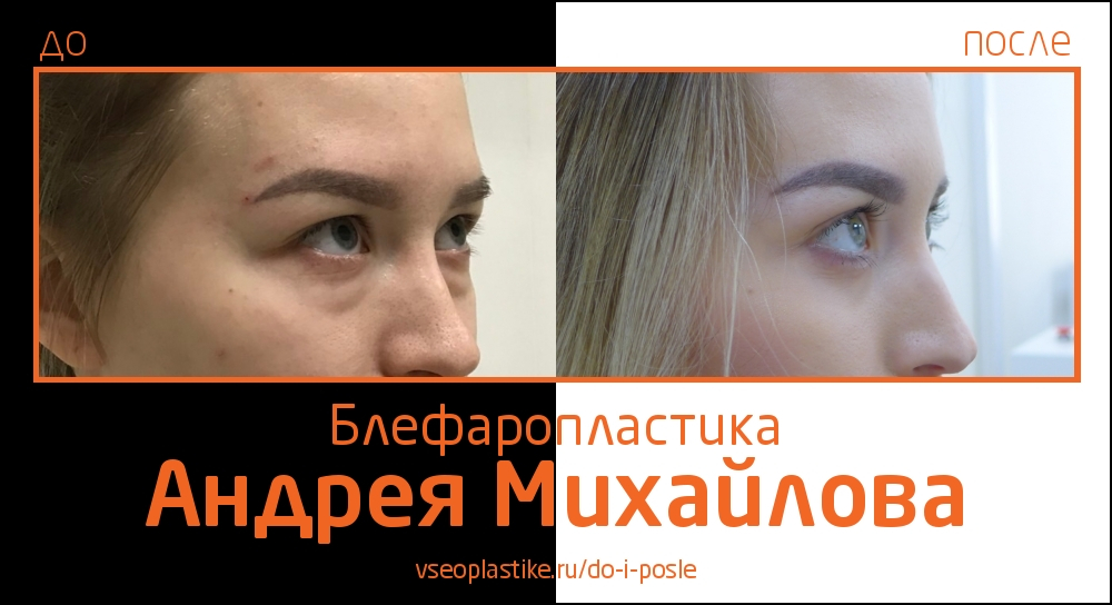 Пластический хирург Андрей Михайлов. Фото до и после блефаропластики