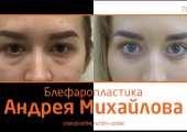 Пластический хирург Андрей Михайлов. До и после блефаропластики