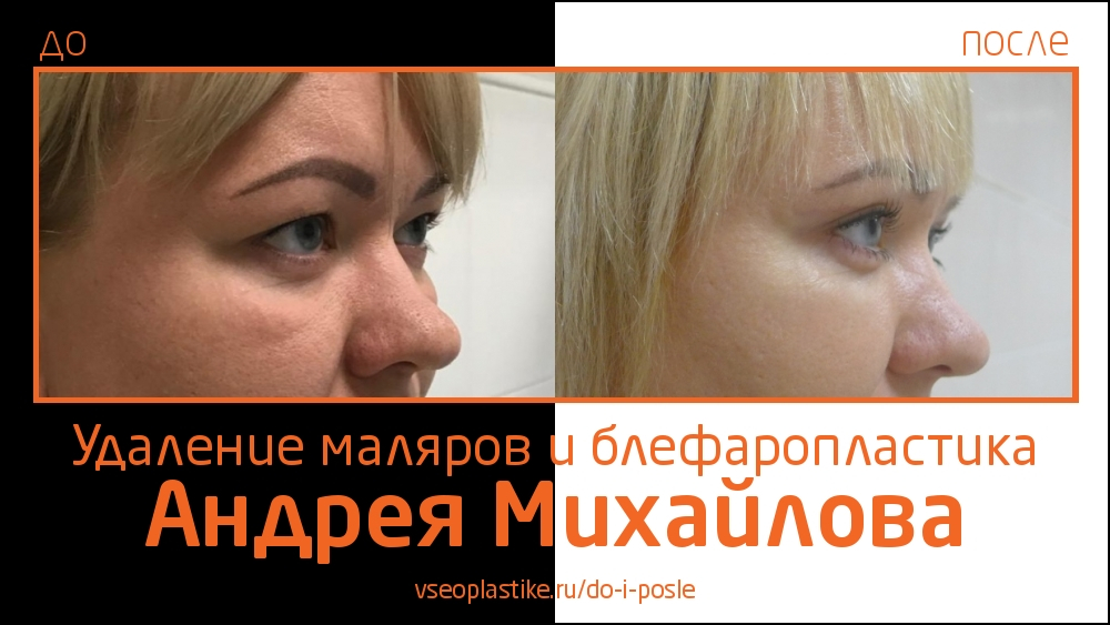 Андрей Михайлов. До и после удаления малярных мешков и круговой блефаропластики