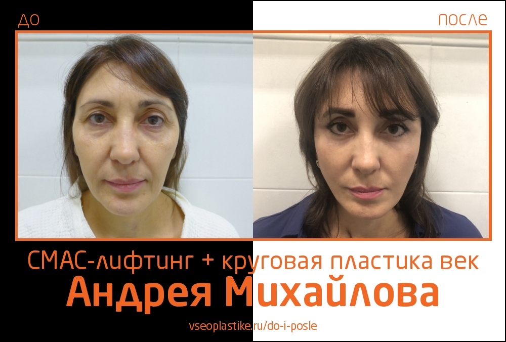 Андрей Михайлов. До и после СМАС-лифтинга и круговой пластики век