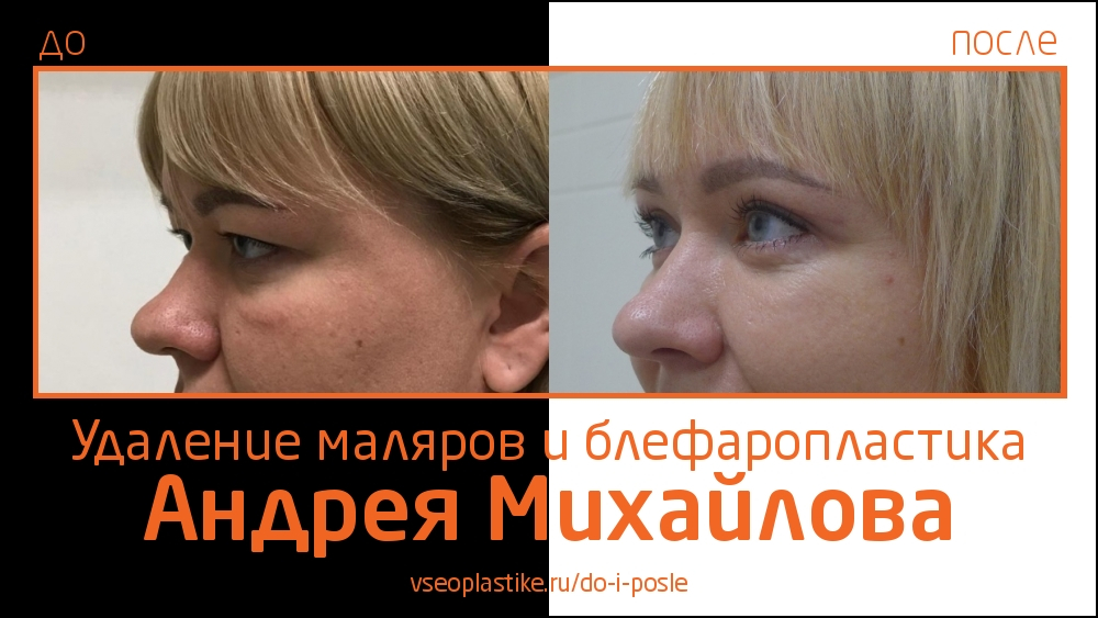 Андрей Михайлов. Фото до и после удаления малярных мешков и пластики век