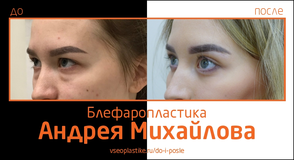 Пластический хирург Андрей Михайлов. Снимки до и после блефаропластики