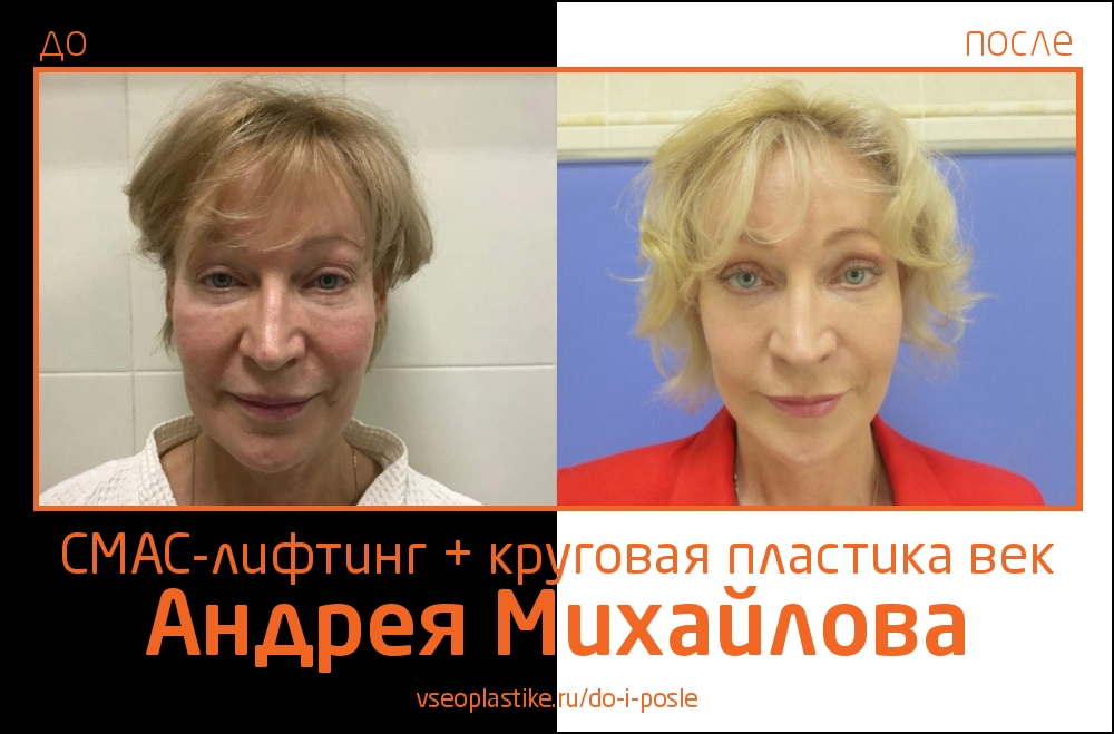 Андрей Михайлов. До и после СМАС-лифтинга и круговой блефаропластики