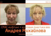 Андрей Михайлов. До и после СМАС-лифтинга и круговой блефаропластики