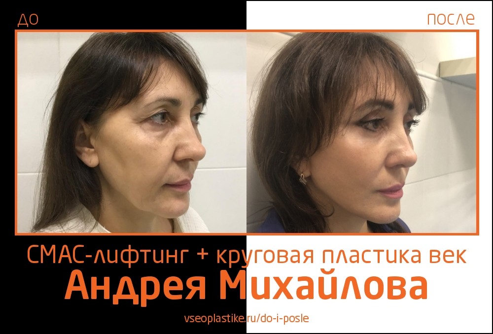 Андрей Михайлов. Снимки до и после СМАС-лифтинга и круговой блефаропластики