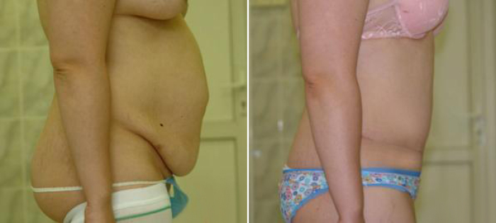 Фото пациентки до и после абдоминопластики у Татьяны Иванченковой